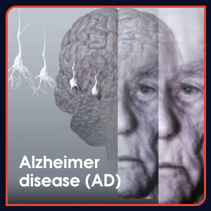 Enfermedad de Alzheimer causada por exceso de aluminio.