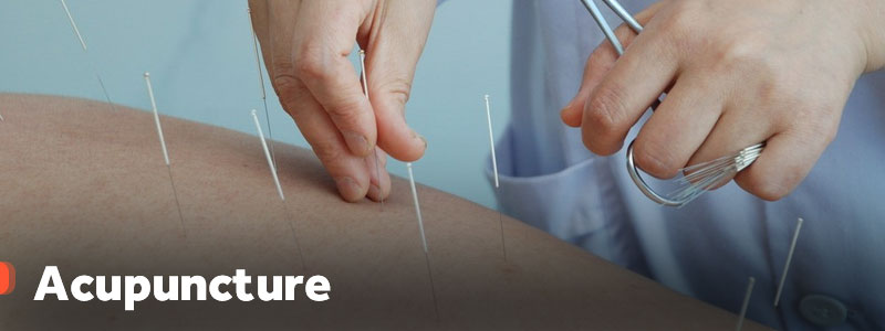 Acupuncture